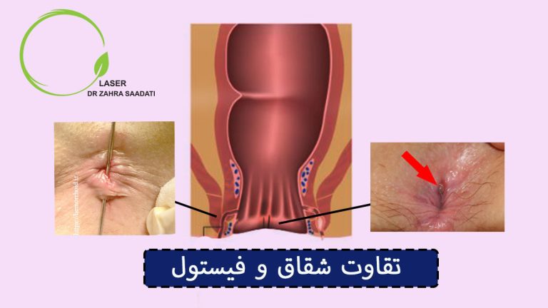 تفاوت شقاق مقعدی و فیستول