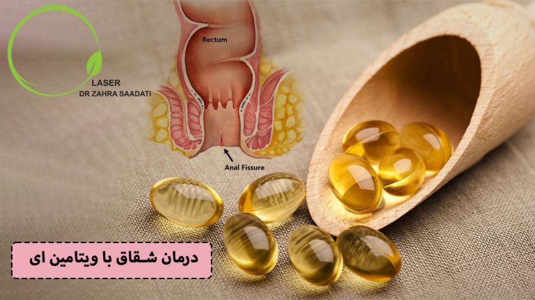 درمان شقاق با ویتامین ای