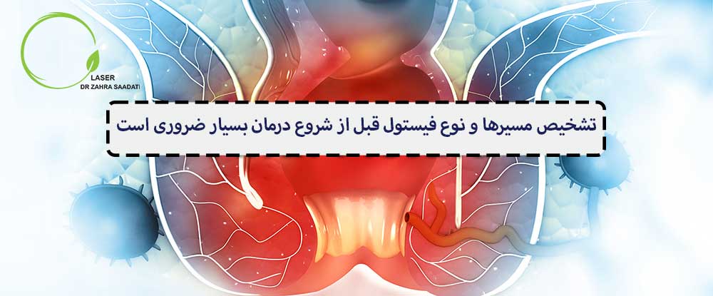 تعیین مسیر و نوع فیستول مقعدی قبل از شروع درمان ضروری است