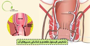 تشخیص فیستول مقعدی و شناسایی مسیرهای آن