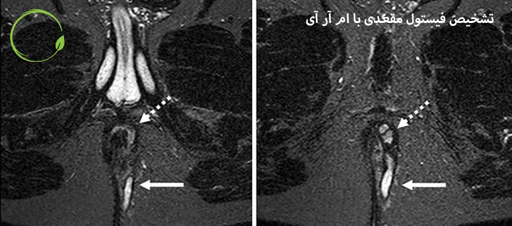 تشخیص فیستول مقعدی با MRI.