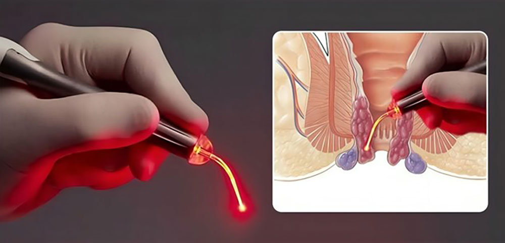 عمل جراحی بواسیر با لیزر