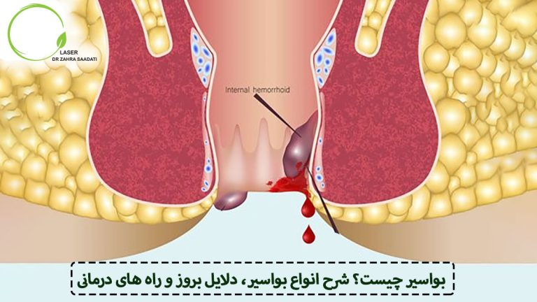 بواسیر چیست؟ شرح انواع بواسیر، دلایل بروز و راه های درمانی