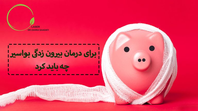 برای درمان بیرون زدگی بواسیر چه باید کرد