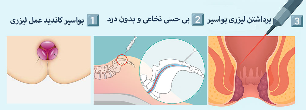 برای آماده سازی برداشتن و عمل لیزری بواسیر از بی حسی نخاعی استفاده می شود.