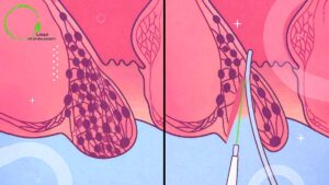 عمل لیزری بواسیر قبل و بعد لیزر هموروئید