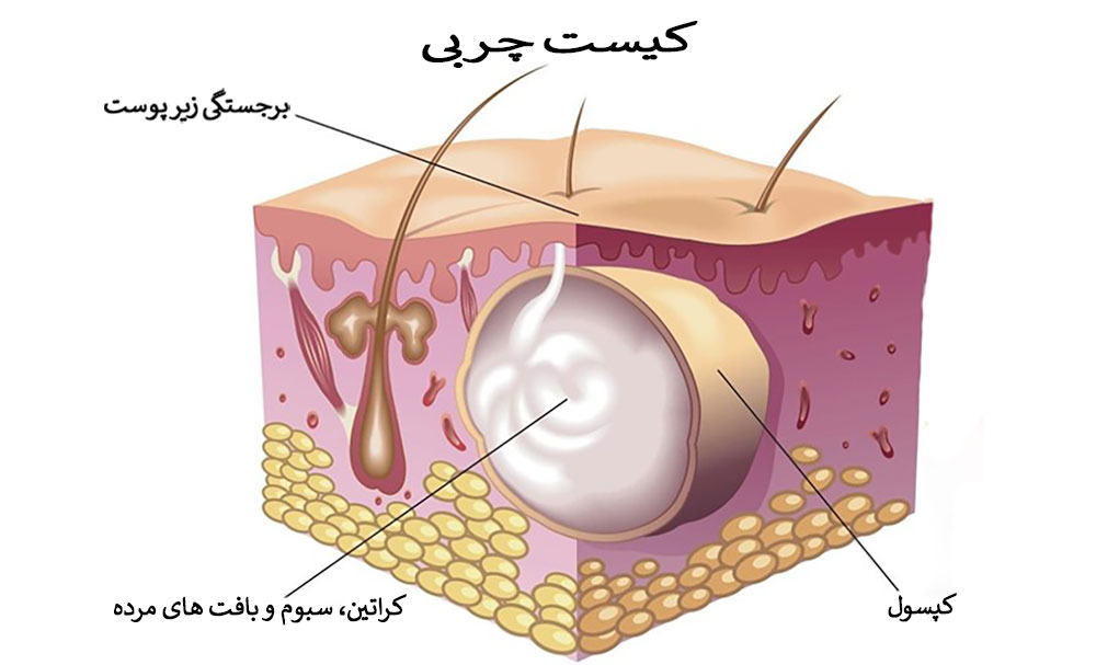 آناتومی کیست چربی