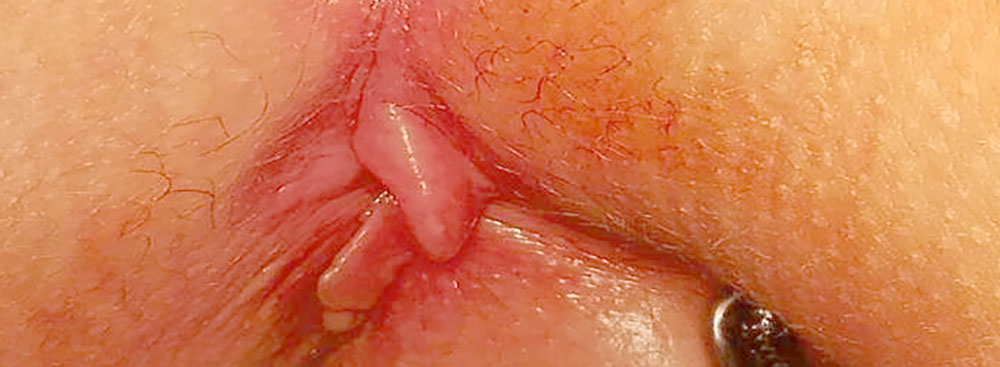 گوشت اضافه مقعدی کودکان