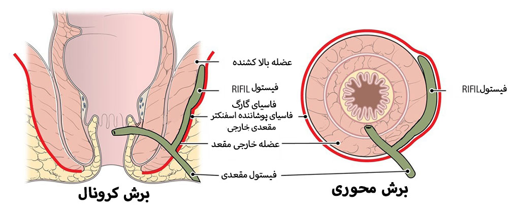 آناتومی فیستول مقعدی از ناحیه محوری و کرونال جهت انجام عمل فیستولوتومی