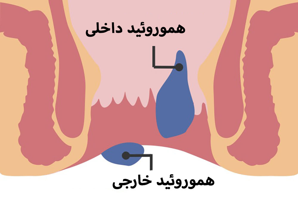 تفاوت هموروئید داخلی و خارجی