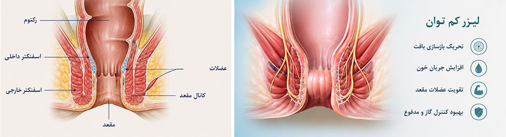 لیزر کم توان برای درمان بی اختیاری مدفوع و گاز